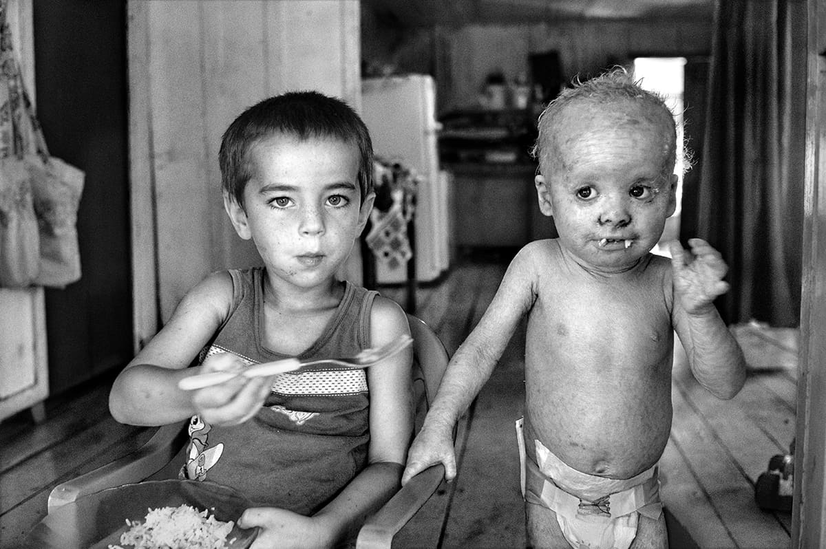 Two small boys in a wooden house, one eating from a plate, the other with visibly affected skin.