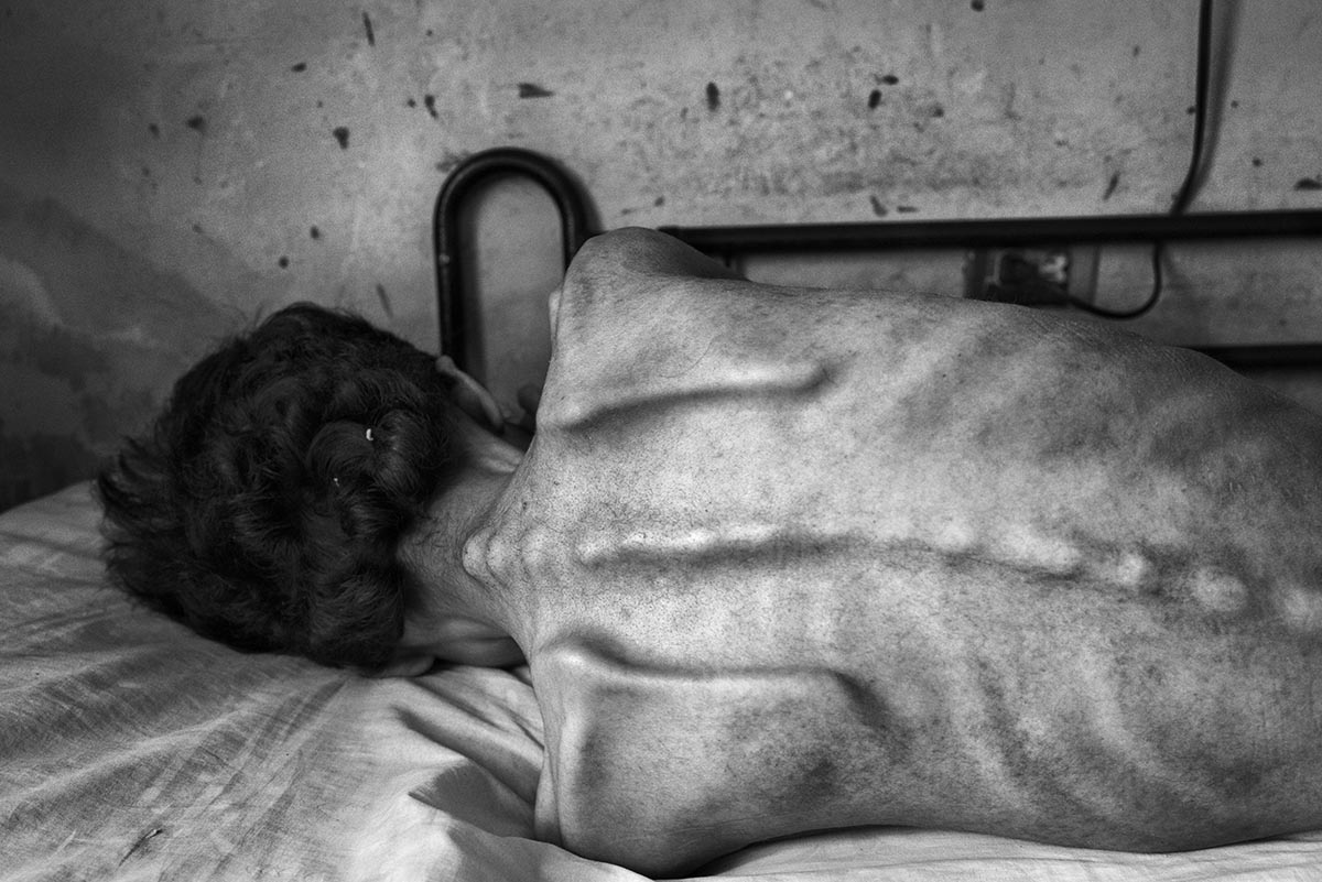 Miguel Blanco, 28, suffers from extreme malnutrition in Alto de Milagros Norte