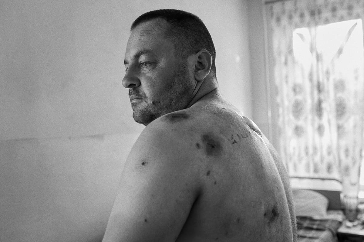 Valentin recovers in a Mykolaiv hospital after a Russian shell hit his house in Lymany.