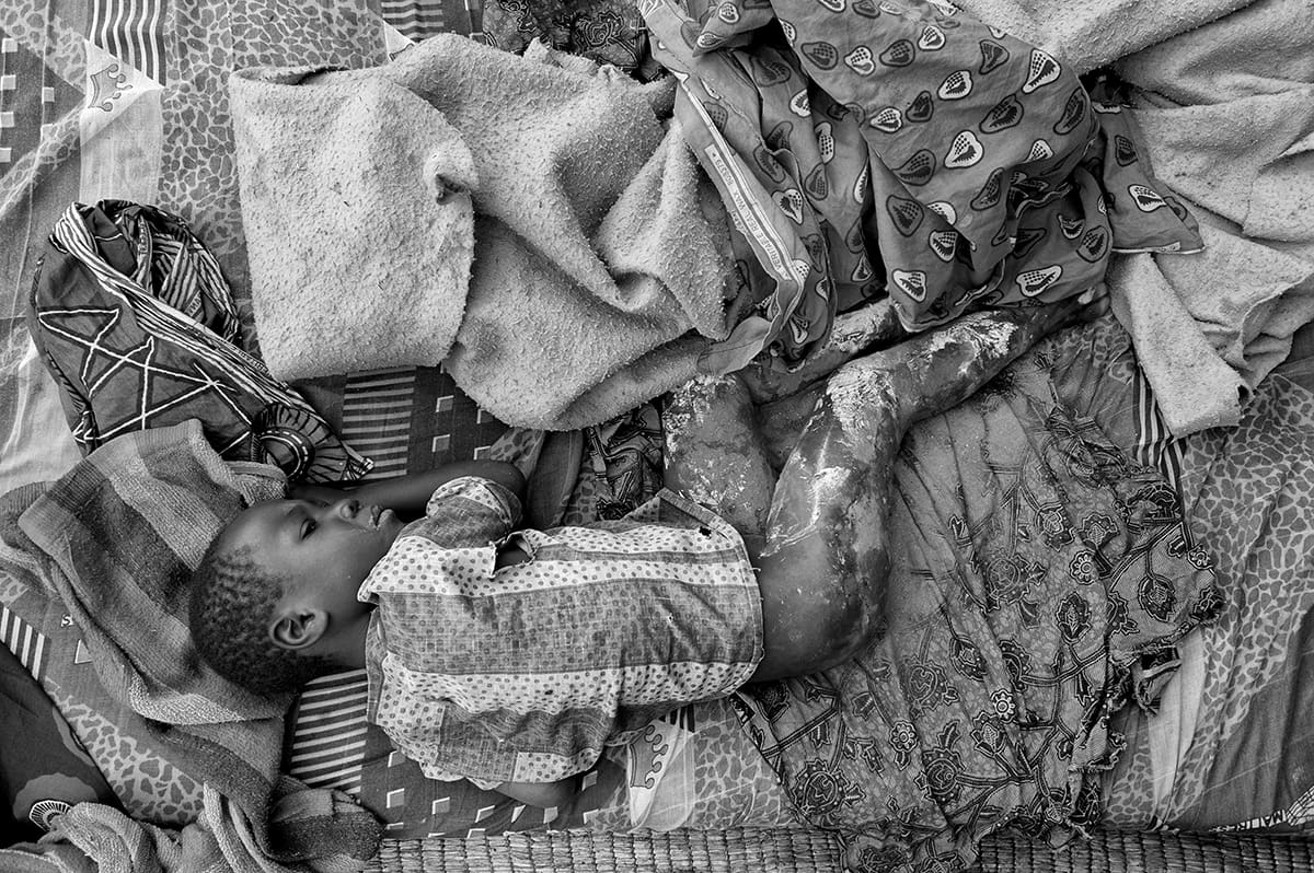 A wounded child resting on a bed inside the Kibati refugee camp in North Kivu, eastern Congo.